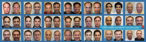 New Hair Transplant Technique In United States Of America Usa New Hair Transplant Technique In United States Of America Usa