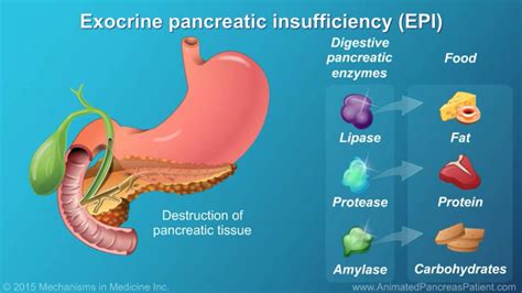 What Is Epi Exocrine Pancreatic Insufficiency What Is Epi Exocrine Pancreatic Insufficiency